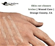 Skin cut closure Irvine | Wound Care | Orange County,  CA